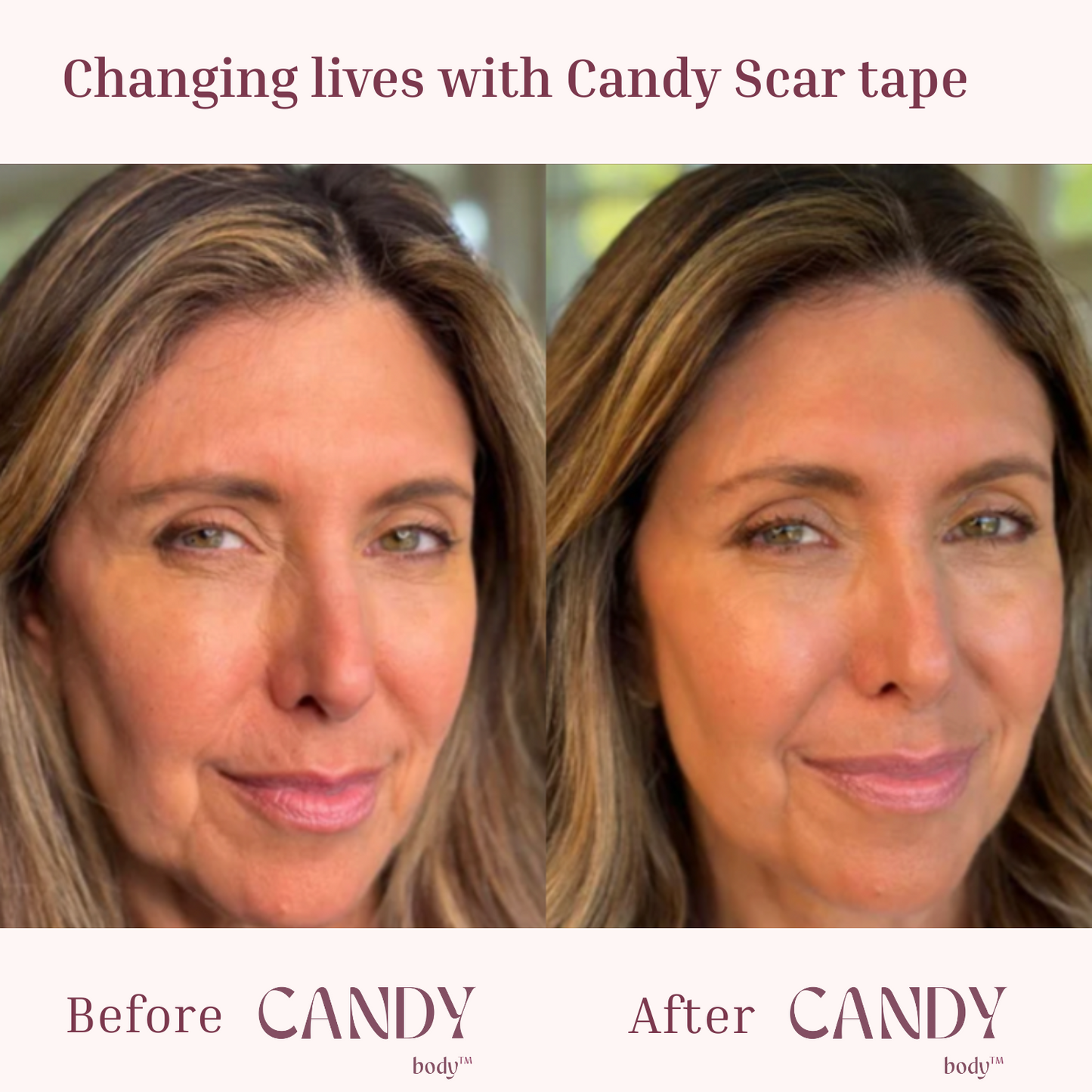 CANDY Scar Tape