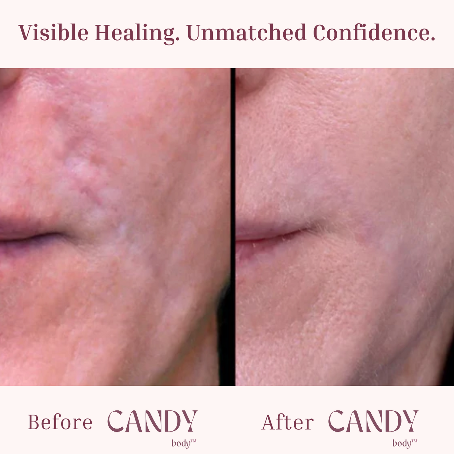 CANDY Scar Tape