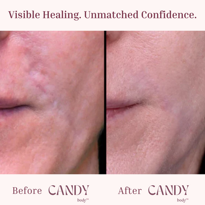 CANDY Scar Tape